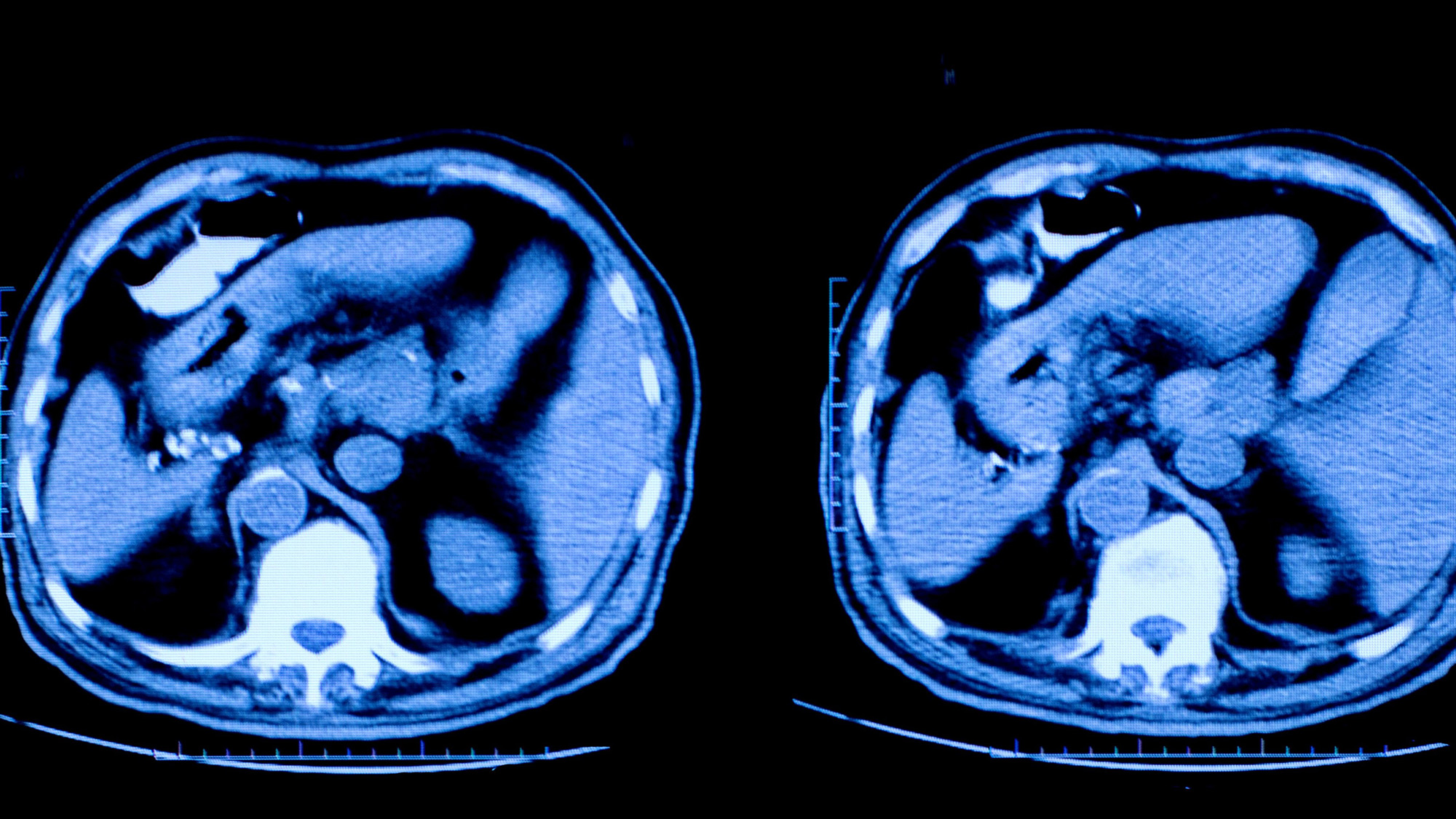 a ct scan