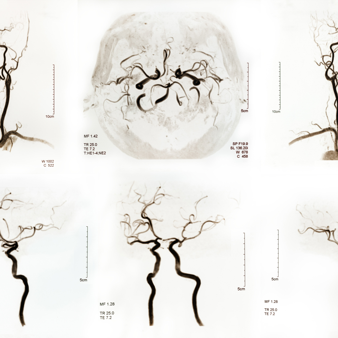 MRI of the brain stroke and cerebral artery image disease. Brain x-ray image.