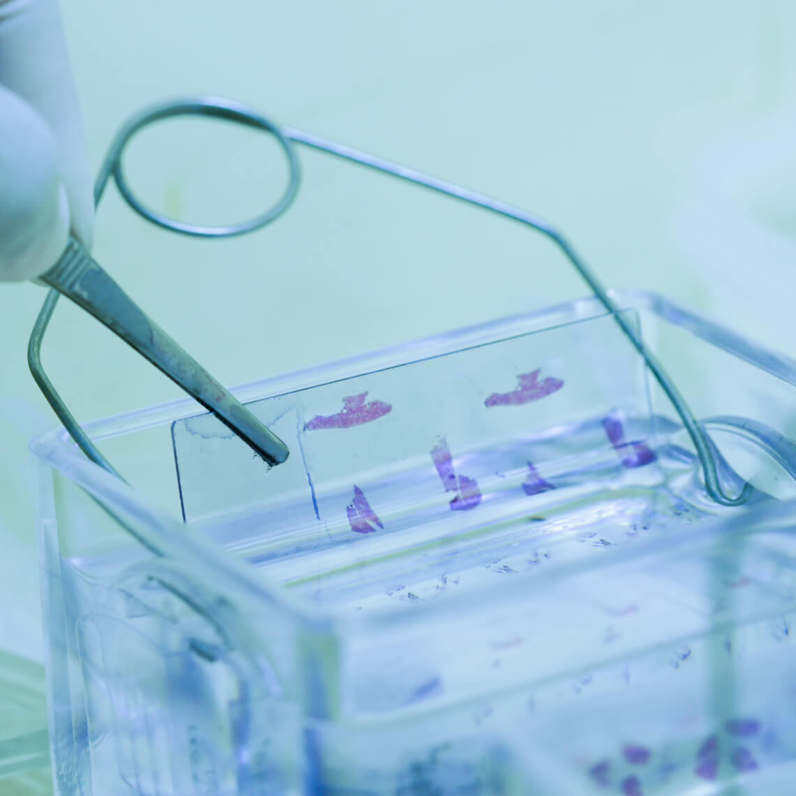 Microscope slide staining tissue biopsy for diagnosis in pathology laboratory. 